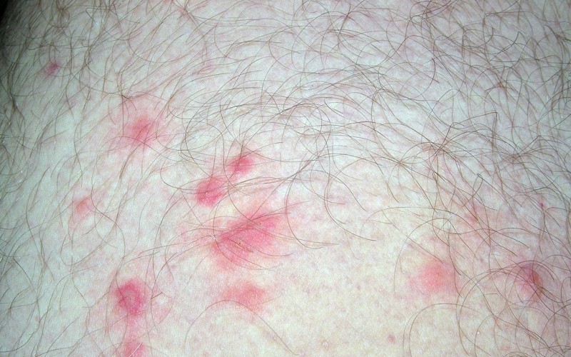 Аллергия на постельных клещей фото thumbnail