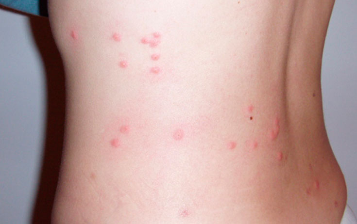 Аллергия на укус блох